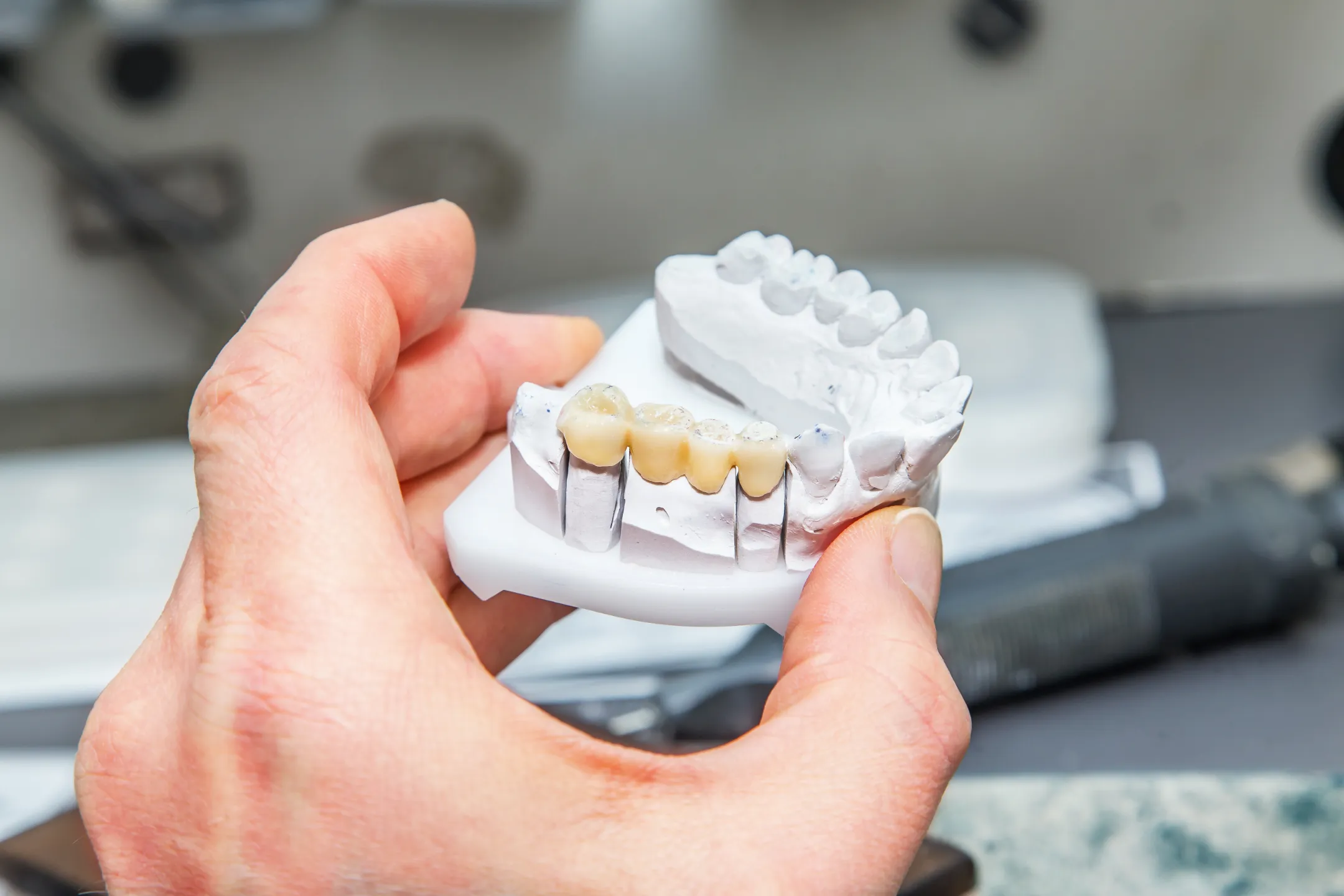 Dental Crowns and Bridges