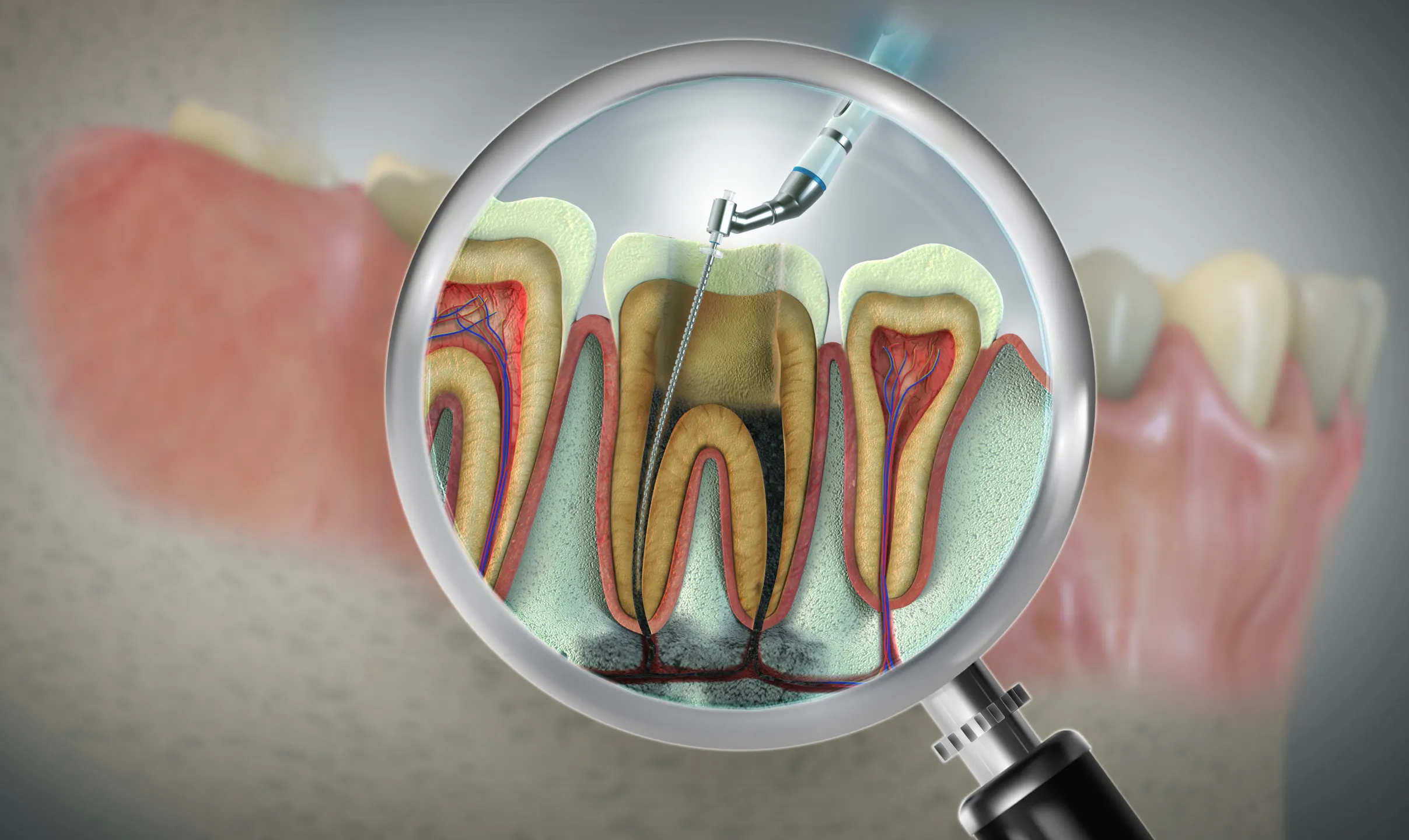 Root Canal / Endodontics